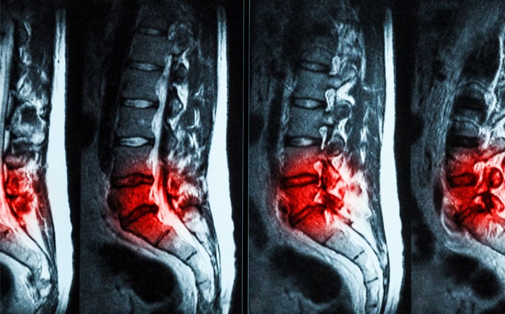 Images of Herniated Discs in the Lower Back - Better Health Chiropractic