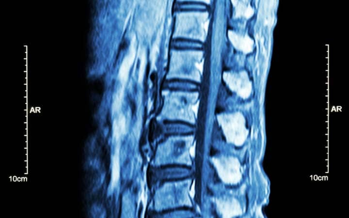 ct scan of the spine showing areas of spine that may need adjusting to provide back and neck pain relief